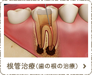 根管治療（歯の根の治療）