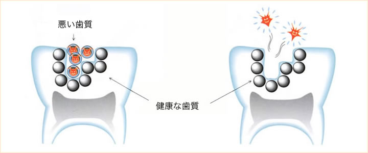 できるだけ削らない虫歯治療