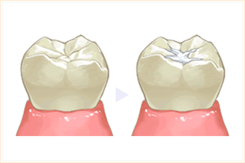 歯の溝を埋める シーラント