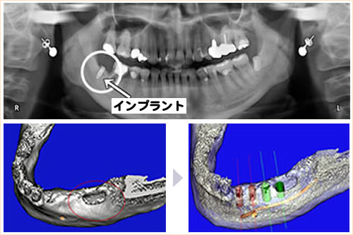 CTシュミレーションインプラント