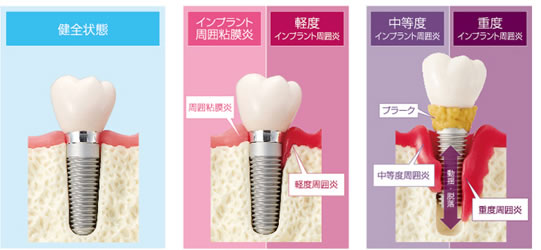 インプラント脱落と歯周病