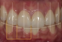 歯の配列・位置
