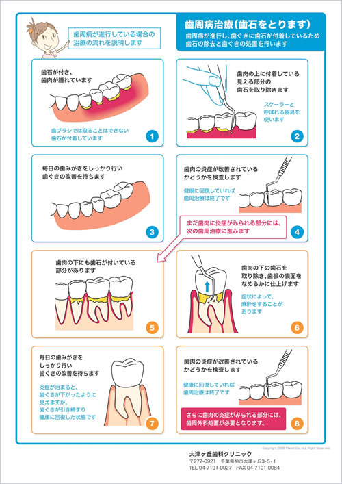 歯石とりの解説