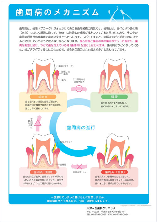 歯周病のメカニズム