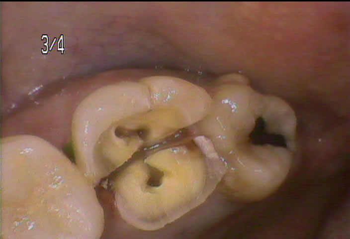 歯牙破折