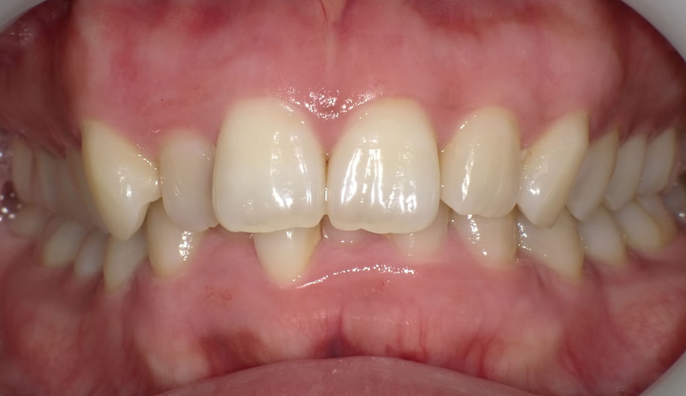 歯肉のホワイトニング治療後
