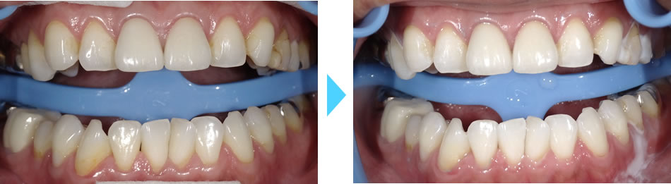ホワイトニング治療ビフォアフター写真