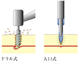 大口式インプラント